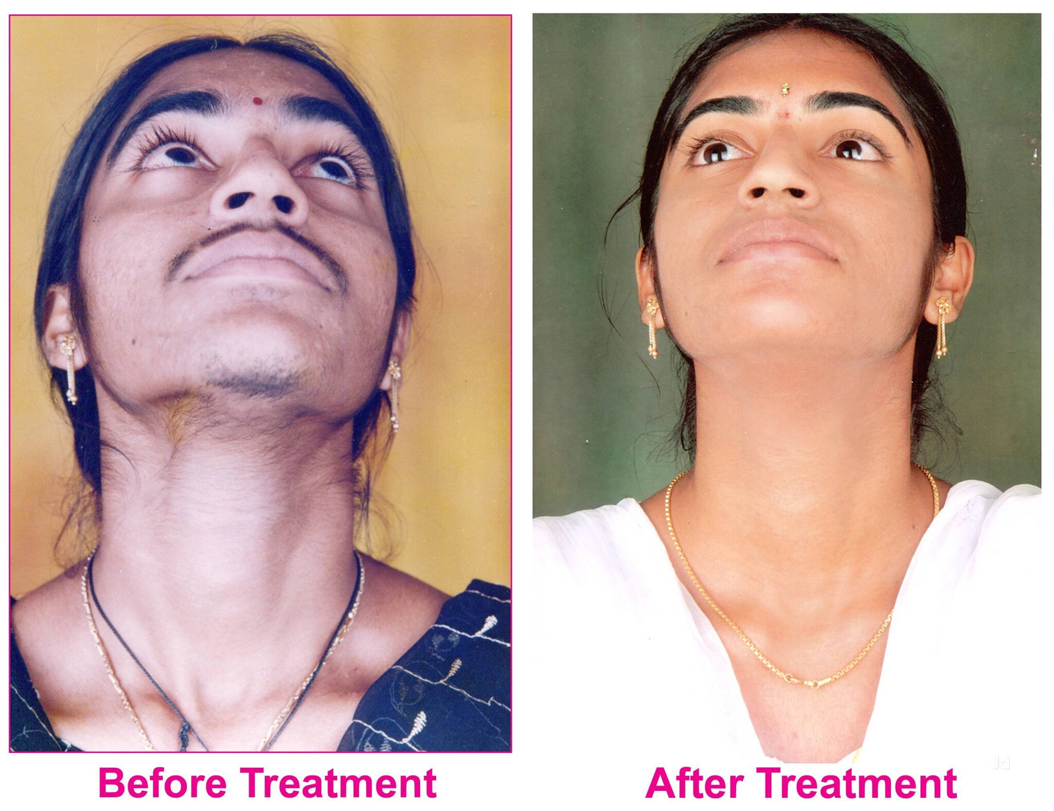 Top Hair Implant Specialists In Nipani Best Hair Transplant