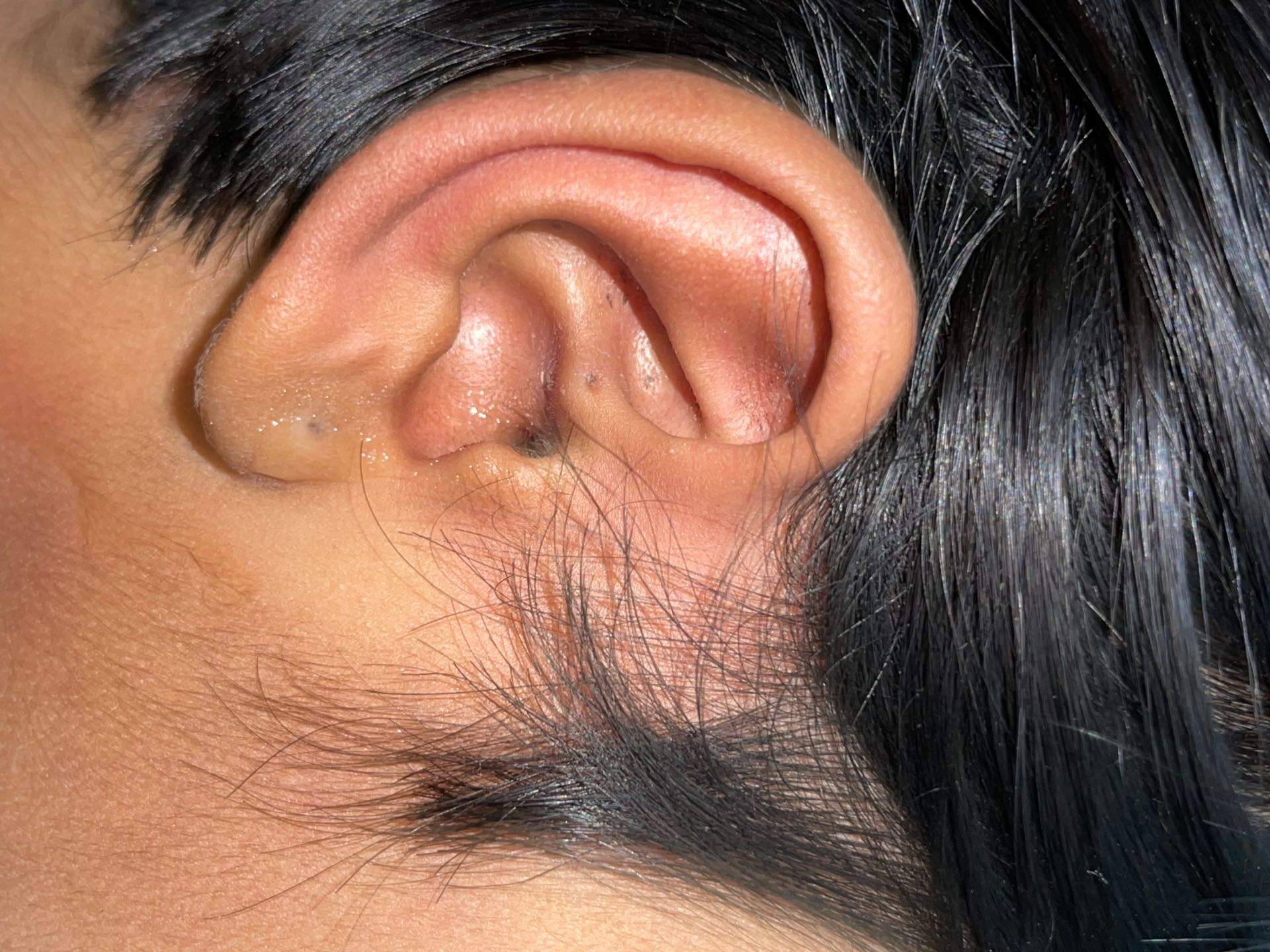 Top Ear Wax Removal Centres in TV Centre RoadHUDCO Best Ent Doctors