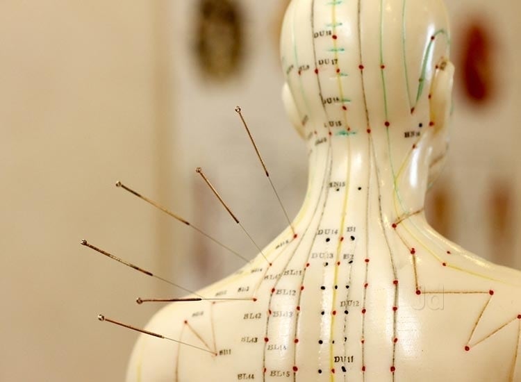 Top 100 Acupuncture Therapists in Delhi Best Acupuncture Doctors