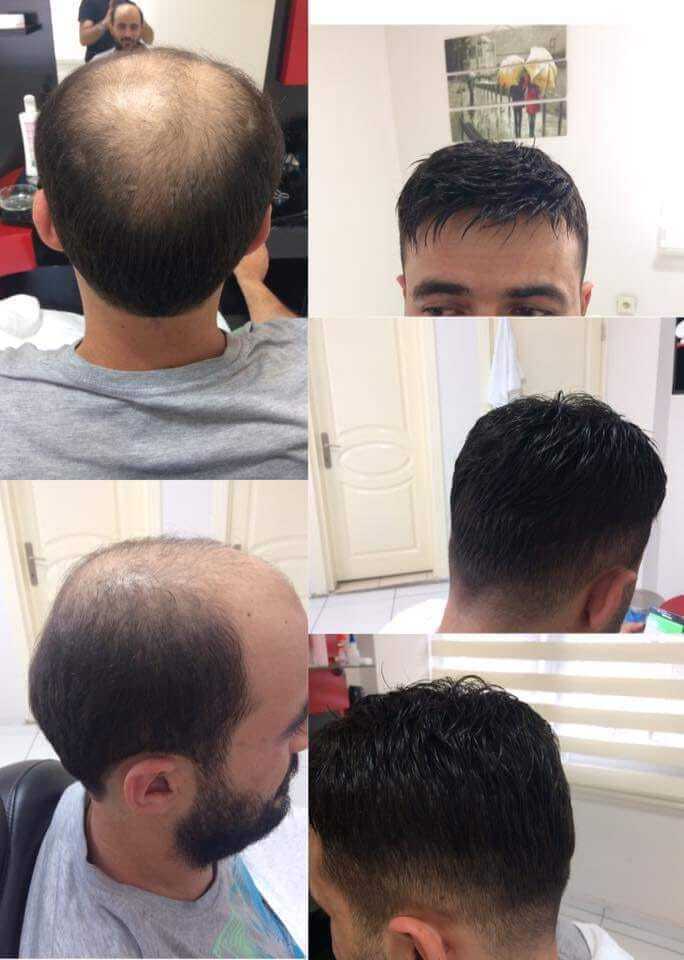 Hair Line India Hair Fixing Center Vijay Nagar Ghaziabad Wig