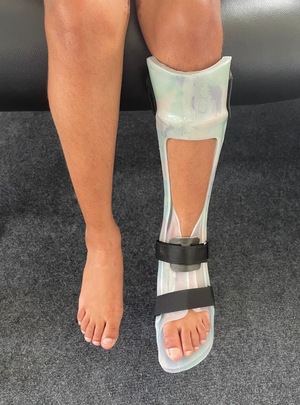 Top Artificial Limb Fitting Centres in Kadappakada Best Artificial