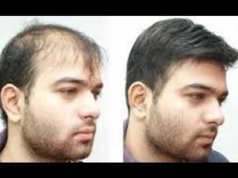 Shiny Hair Fixing Hair Transplant Clinics Book Appointment