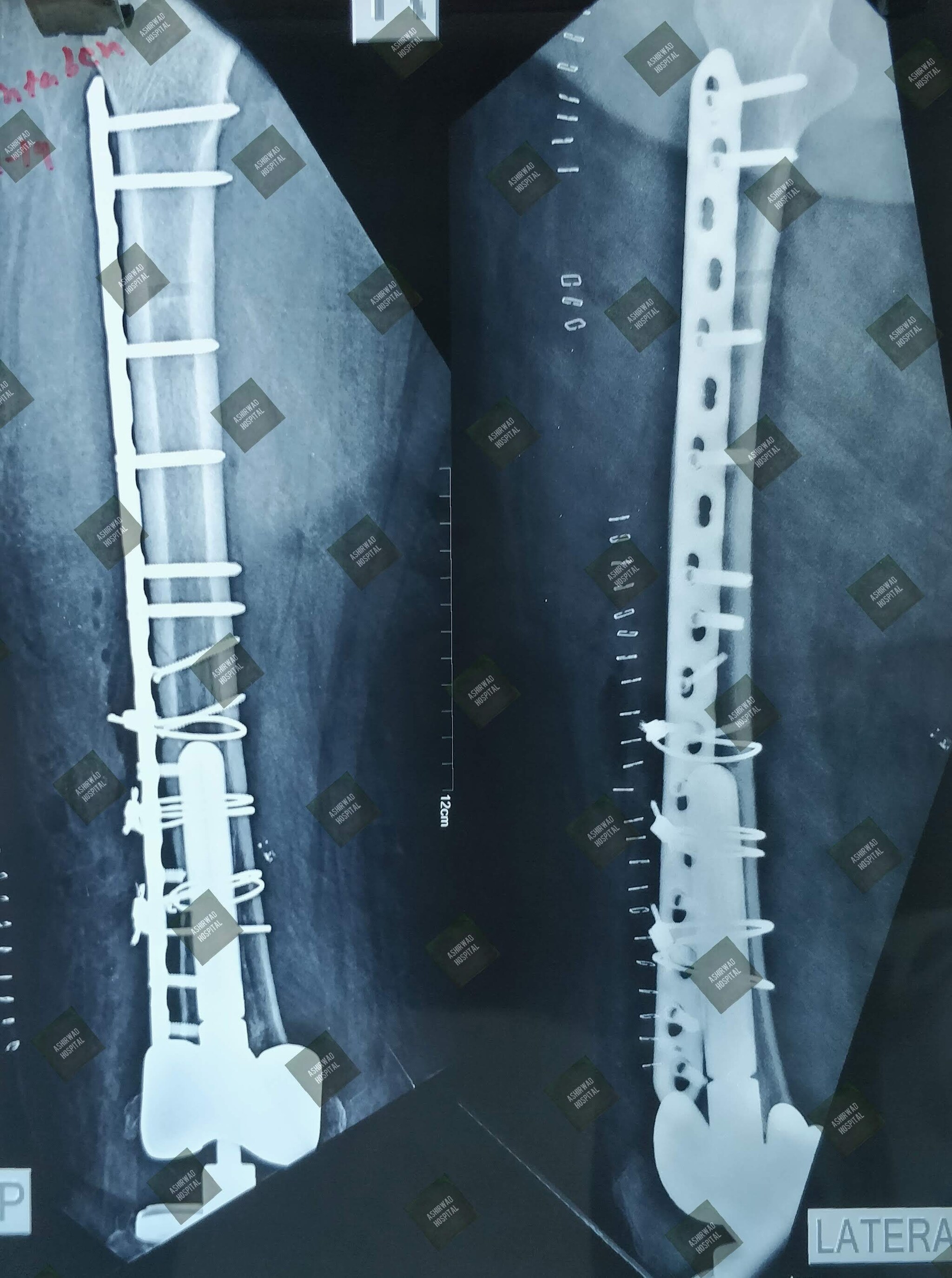 Top Knee Replacement Surgeons Doctors in Atladara, Vadodara Best Knee