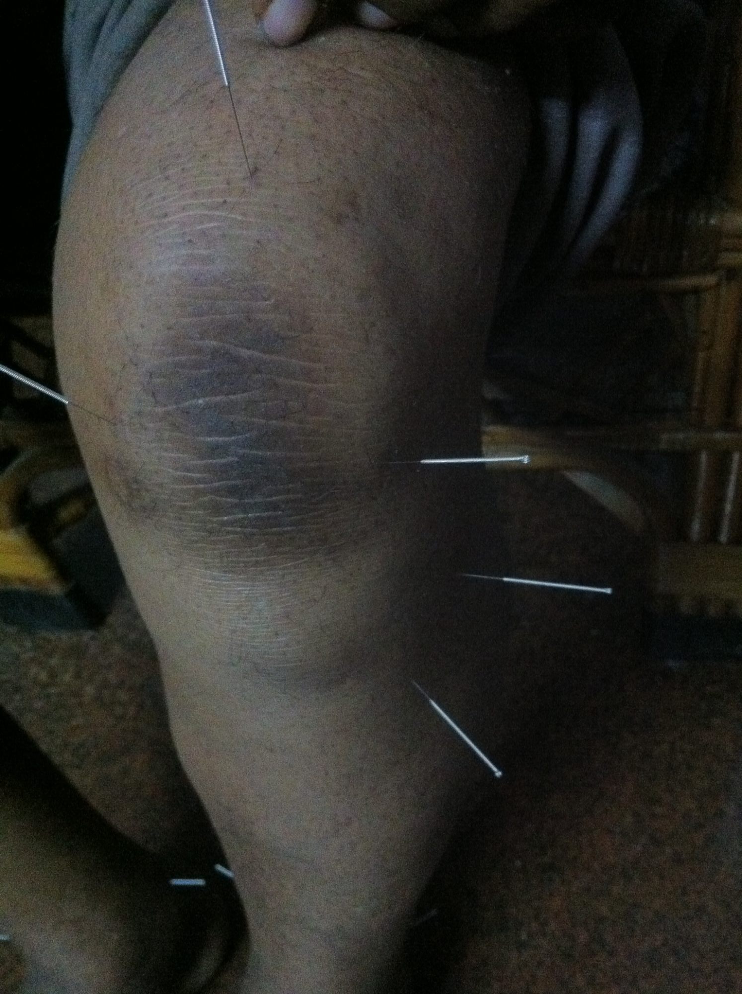 Top Corn Removal Doctors in Cubbonpet, Bangalore Best Wart Removal