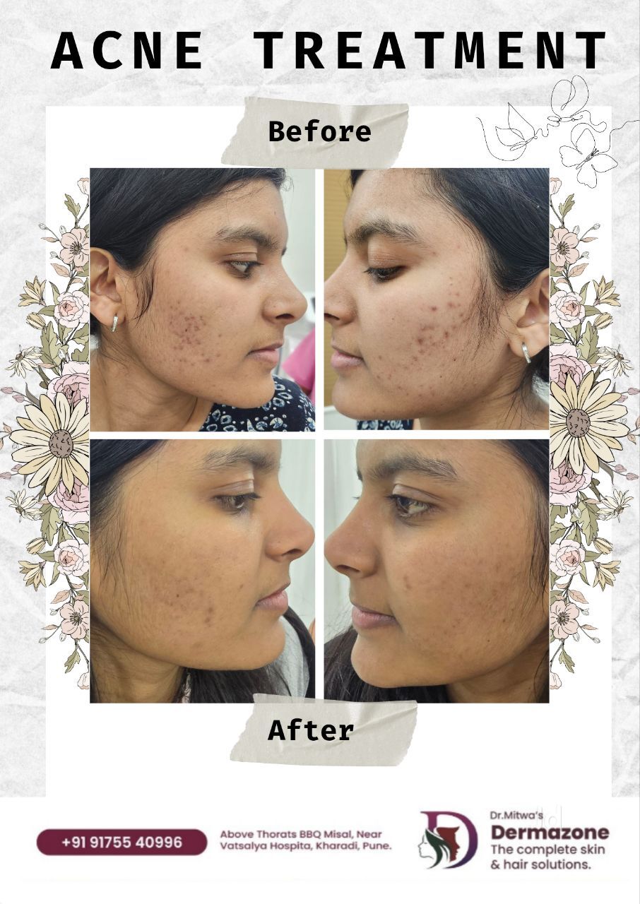 glutathione skin whitening treatment in pune Top Leprosy Doctors With For Lohegaon, - Best Leprosy Doctors With Glutathione For Skin Whitening - 𝗕𝗼𝗼𝗸 𝗔𝗽𝗽𝗼𝗶𝗻𝘁𝗺𝗲𝗻𝘁 𝗢𝗻𝗹𝗶𝗻𝗲 near me Vitamin B12 Injection Several lines of antioxidant Bundle & Save:Buy 2 Get 1 Free